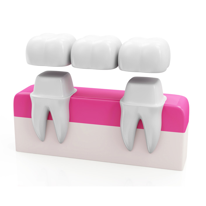 Dental Bridges