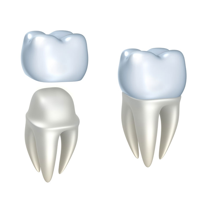 Dental Crowns