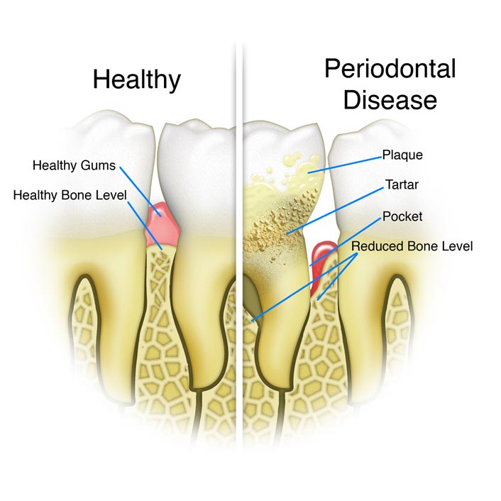 Gum (Periodontal) Treatment