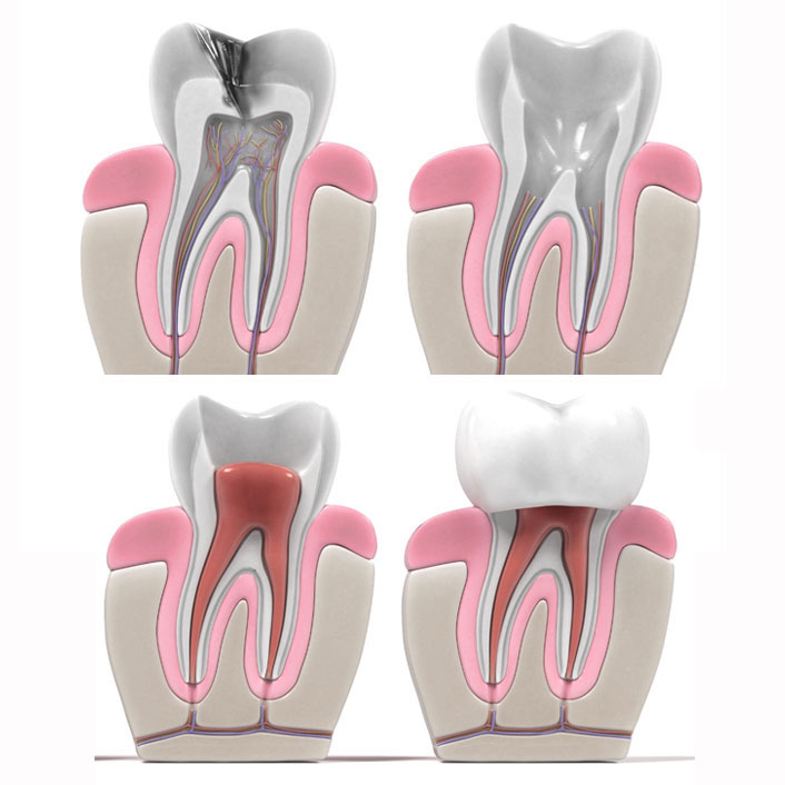 Root Canal