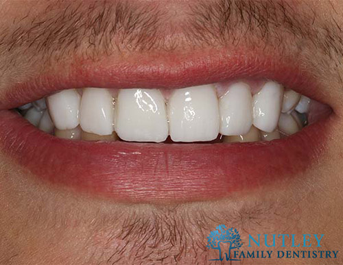 Smile Makeover with Composite