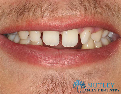 Smile Makeover with Composite