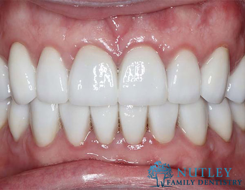 Smile Makeover with Composite