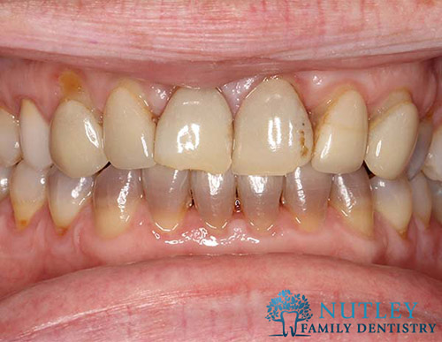 Smile Makeover with Composite