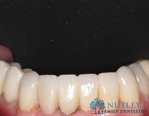 lower porcelain veneers