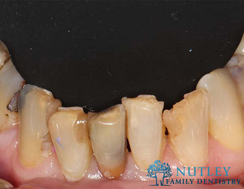 lower porcelain veneers