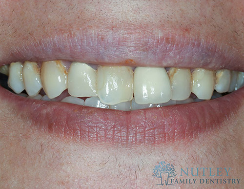 Smile Makeover with Composite