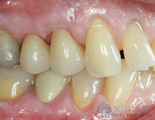 lower porcelain veneers