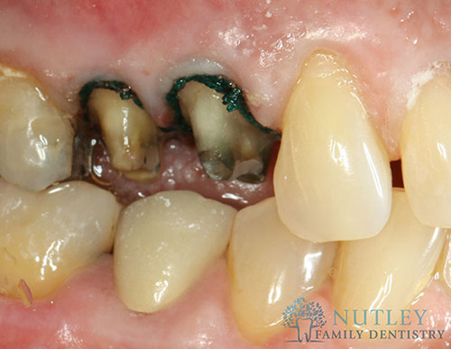 lower porcelain veneers