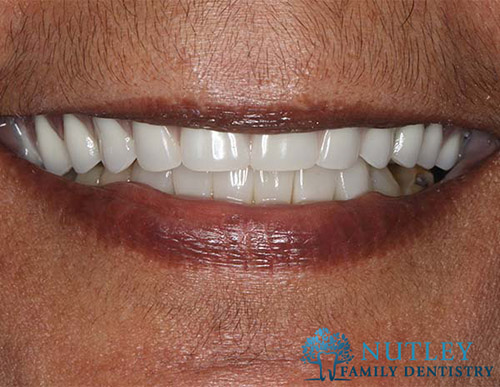 Smile Makeover with Composite