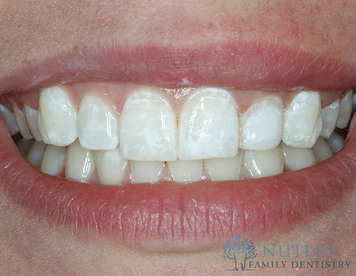 lower porcelain veneers