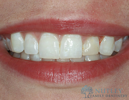 lower porcelain veneers