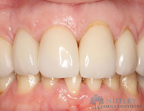 lower porcelain veneers