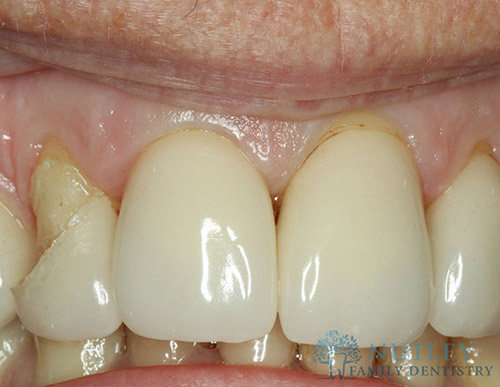 lower porcelain veneers