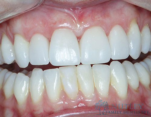 GUM GRAFTING AND VENEERS