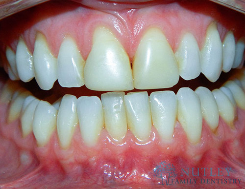 GUM GRAFTING AND VENEERS