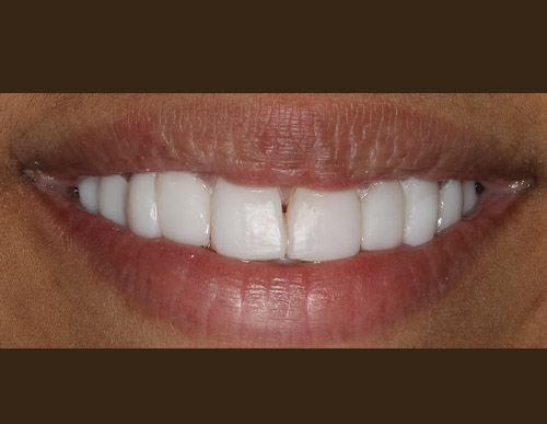 Composite restorations