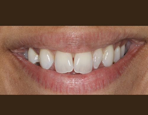 Composite restorations